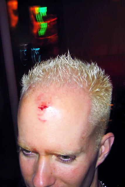 James' Rock Star Wound